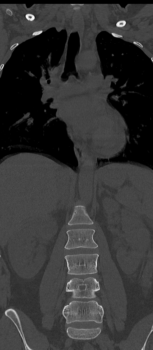 Normal thoracolumbar spine (Radiopaedia 43822-47309 Coronal bone window 37).png