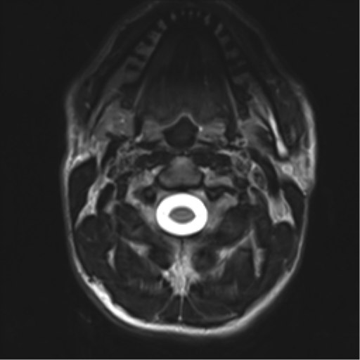 File:Normal trauma cervical spine (Radiopaedia 41017-43762 D 3).png