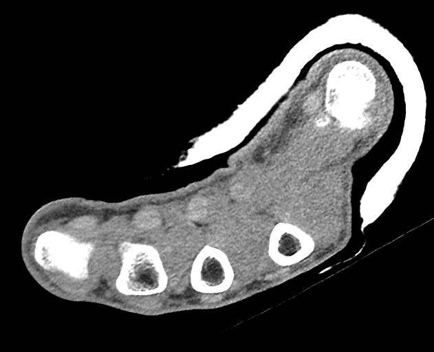 Normal wrist CT (Radiopaedia 41425-44297 Axial non-contrast 9).png