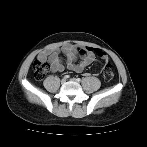 File:Obstructing ureteric calculus (Radiopaedia 18615-18514 B 37).jpg