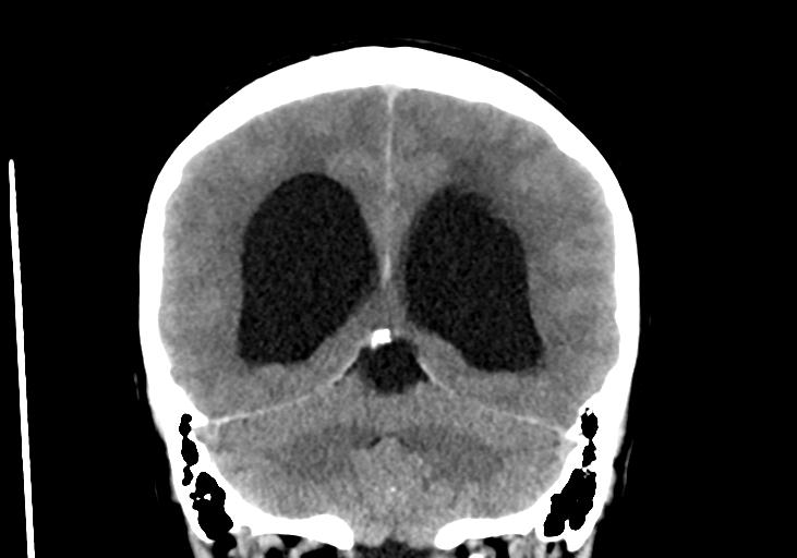 File:Obstructive hydrocephalus (Radiopaedia 30453-31119 Coronal non-contrast 27).jpg