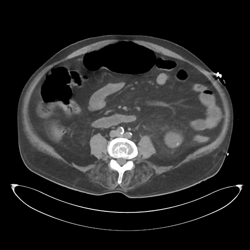 File:Obstructive pyelonephritis (Radiopaedia 46411-50844 Axial non-contrast 45).png