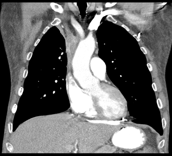 File:Obstructive superior vena cava tumor thrombus (Radiopaedia 28046-28306 B 19).jpg