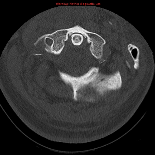 File:Occipital condyle fracture (Radiopaedia 18366-18208 Axial bone window 16).jpg