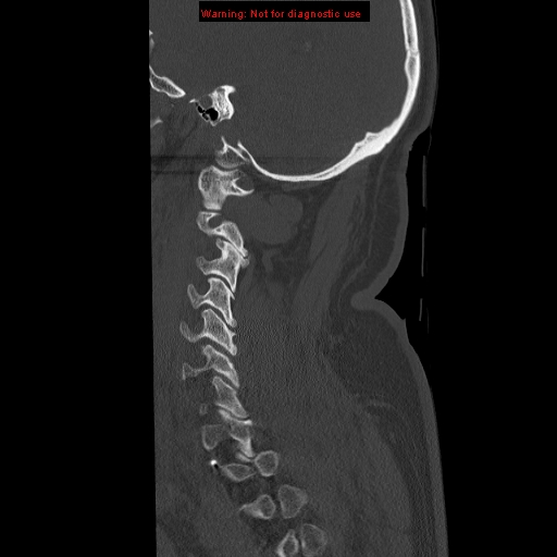 File:Occipital condyle fracture (Radiopaedia 18366-18208 Sagittal bone window 7).jpg