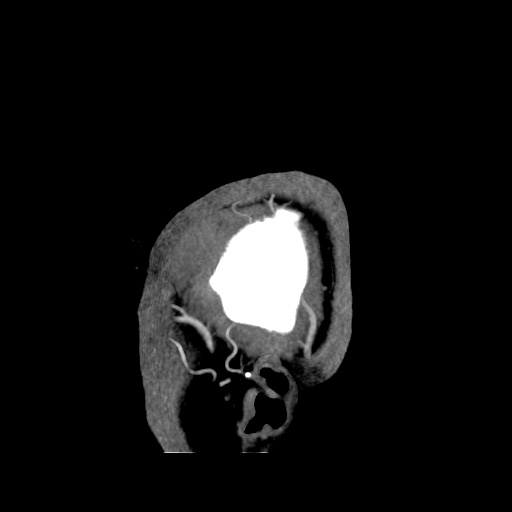 Occipital extradural hematoma simulating venous sinus thrombosis (Radiopaedia 46514-50964 D 3).jpg