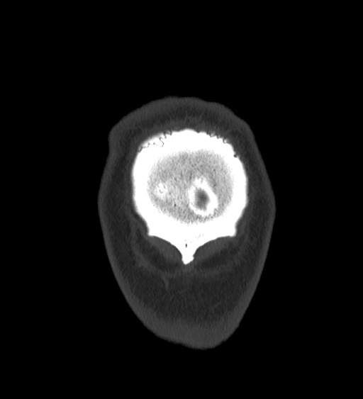 Occipital spur and Currarino type A atlas anomaly (Radiopaedia 87027-103285 Coronal bone window 143).jpg