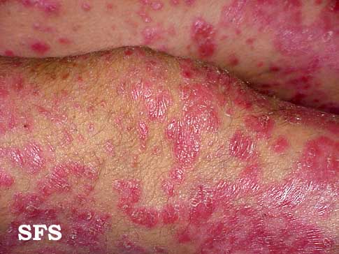 File:Psoriasis (Dermatology Atlas 4).jpg