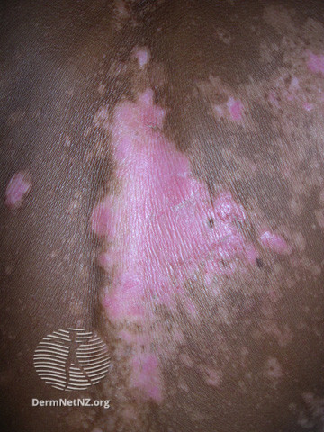 File:Sunburn in vitiligo (DermNet NZ colour-sunburn-vitiligo2).jpg