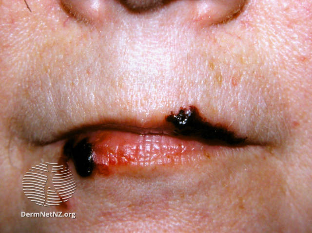 (DermNet NZ herpes-simplex-labialis-20).jpg