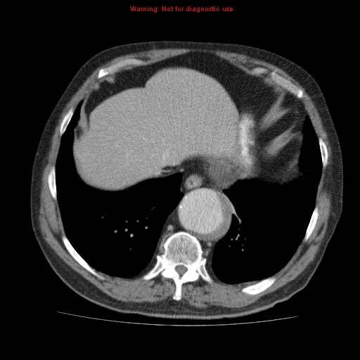 Abdominal aortic aneurysm (Radiopaedia 10122-10660 Axial C+ portal venous phase 8).jpg