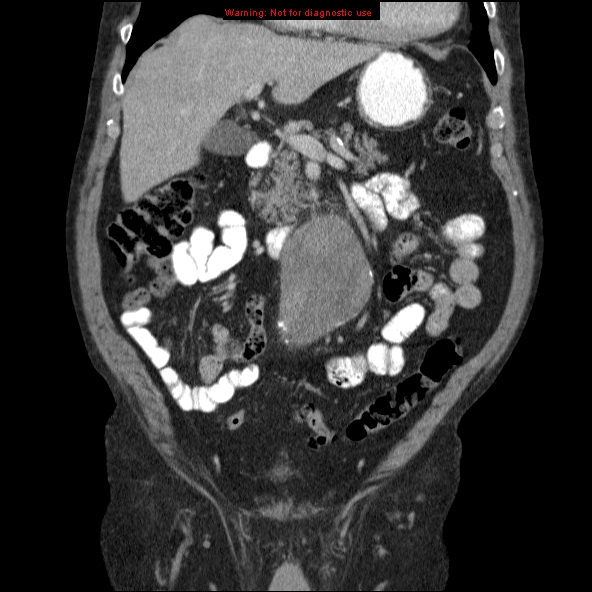 File:Abdominal aortic aneurysm (Radiopaedia 10122-10660 Coronal C+ portal venous phase 10).jpg
