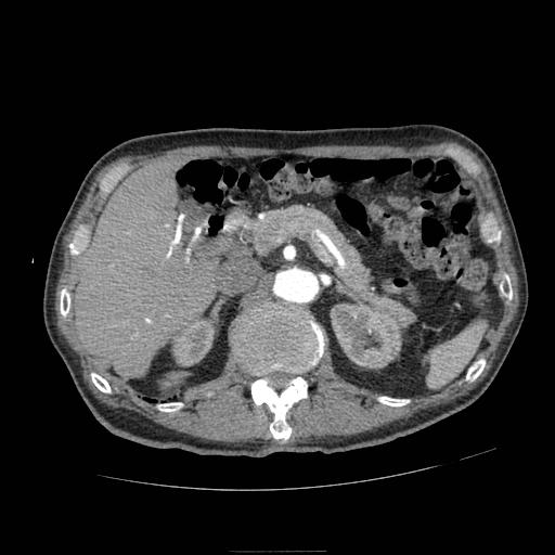 Abdominal aortic aneurysm (Radiopaedia 13341-13340 Axial C+ arterial phase 57).jpg