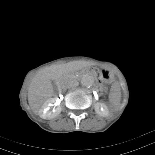 File:Abdominal aortic aneurysm (Radiopaedia 20827-20742 Axial C+ delayed 12).jpg