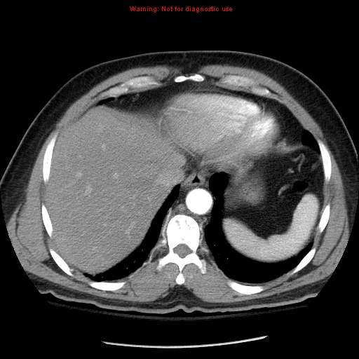 Abdominal aortic aneurysm (Radiopaedia 8190-9038 Axial C+ arterial phase 9).jpg
