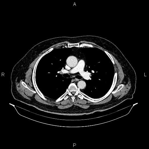 Abdominal aortic aneurysm (Radiopaedia 83094-97462 Axial renal cortical phase 34).jpg