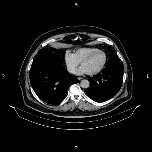 File:Abdominal aortic aneurysm (Radiopaedia 83094-97462 Axial renal excretory phase 6).jpg