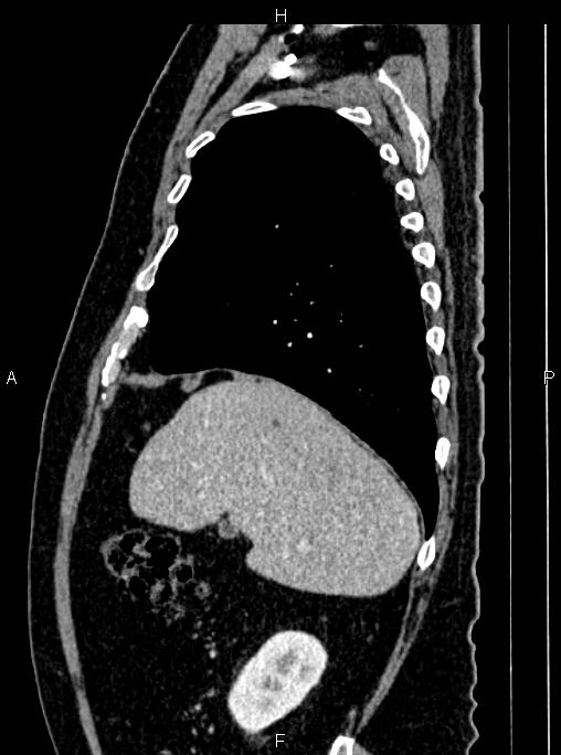 Abdominal aortic aneurysm (Radiopaedia 83094-97462 Sagittal renal cortical phase 32).jpg