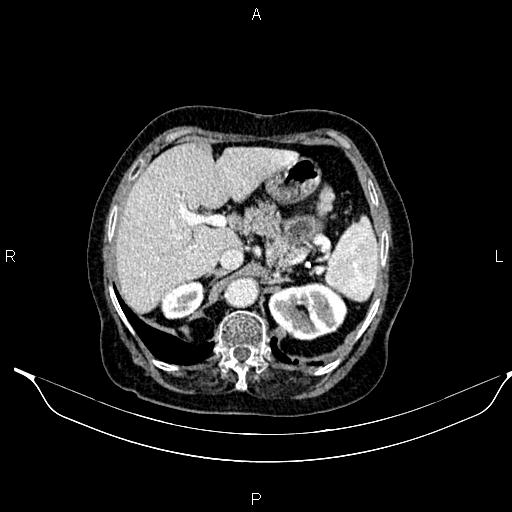 File:Abdominal aortic aneurysm (Radiopaedia 85063-100606 Axial C+ portal venous phase 32).jpg