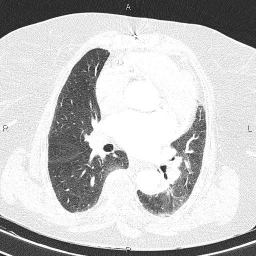File:Abdominal aortic aneurysm (Radiopaedia 85063-100606 Axial lung window 35).jpg