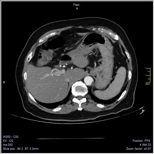 Abdominal aortic aneurysm with thrombus fissuration (Radiopaedia 47340-51926 Axial C+ arterial phase 7).jpg