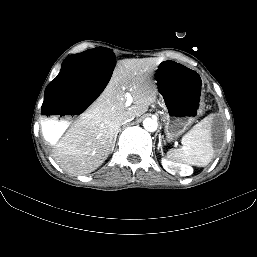 File:Abdominal collection due to previous cecal perforation (Radiopaedia 80831-94320 Axial C+ portal venous phase 46).jpg