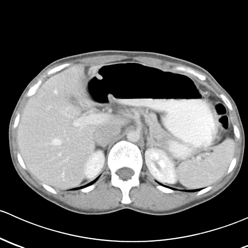 Abdominal desmoid tumor (Radiopaedia 41007-43740 Axial C+ portal venous phase 15).png