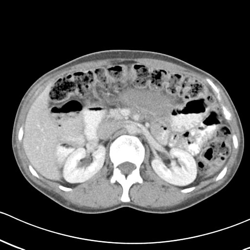 File:Abdominal desmoid tumor (Radiopaedia 41007-43740 Axial C+ portal venous phase 21).png