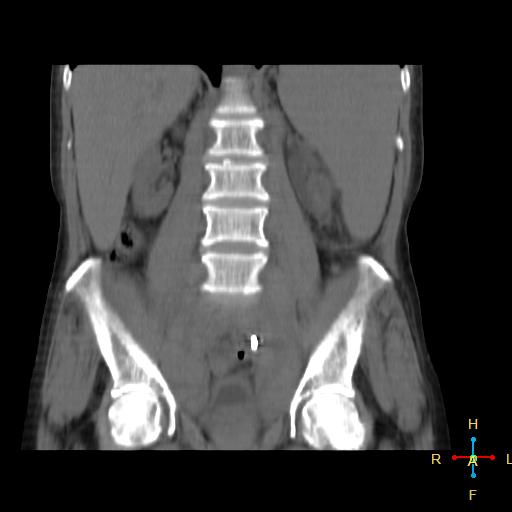 File:Abdominal lymphoma (Radiopaedia 23085-23115 Coronal non-contrast 10).jpg