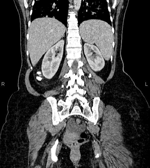 Abdominal lymphoma with sandwich sign (Radiopaedia 84378-99704 Coronal C+ portal venous phase 50).jpg