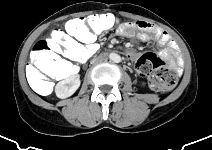 Abdominal wall and retroperitoneal tuberculosis (Radiopaedia 88137-104729 Axial C+ portal venous phase 98).jpg