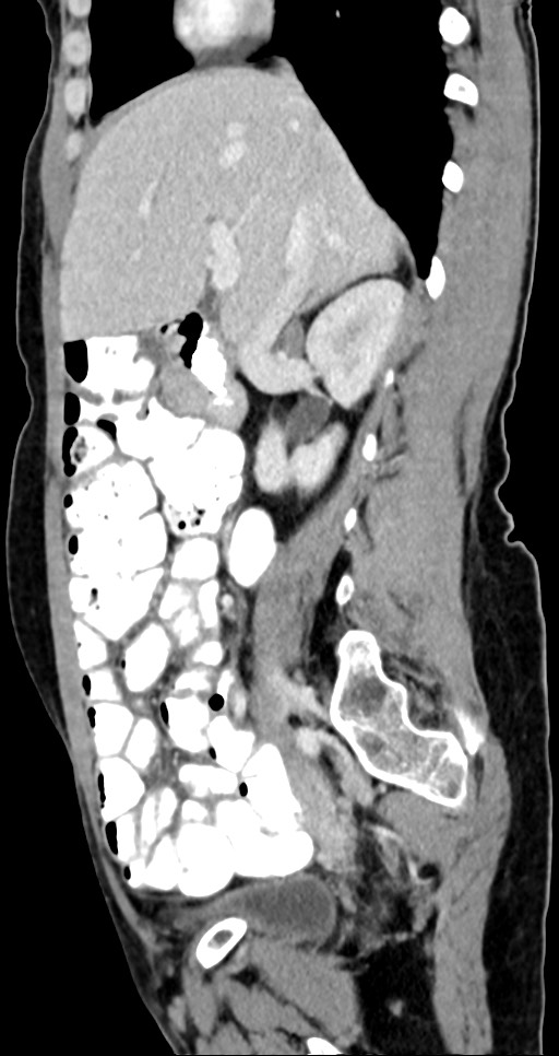 Abdominal wall and retroperitoneal tuberculosis (Radiopaedia 88137-104729 Sagittal C+ portal venous phase 95).jpg