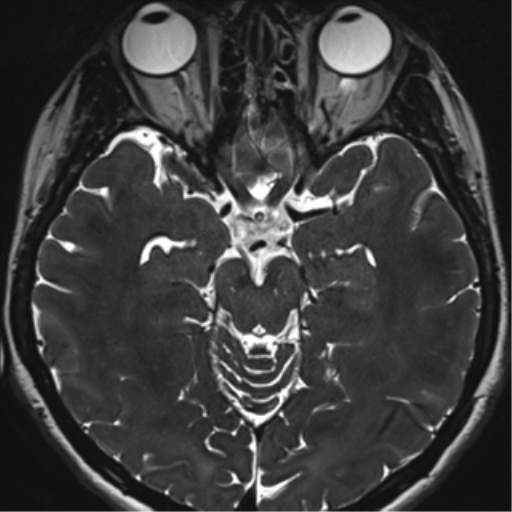 Abducens nerve palsy (Radiopaedia 51069-56648 Axial T2 fat sat 62).png