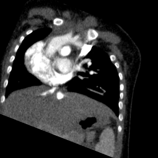 File:Aberrant left pulmonary artery (pulmonary sling) (Radiopaedia 42323-45435 Coronal C+ CTPA 15).jpg