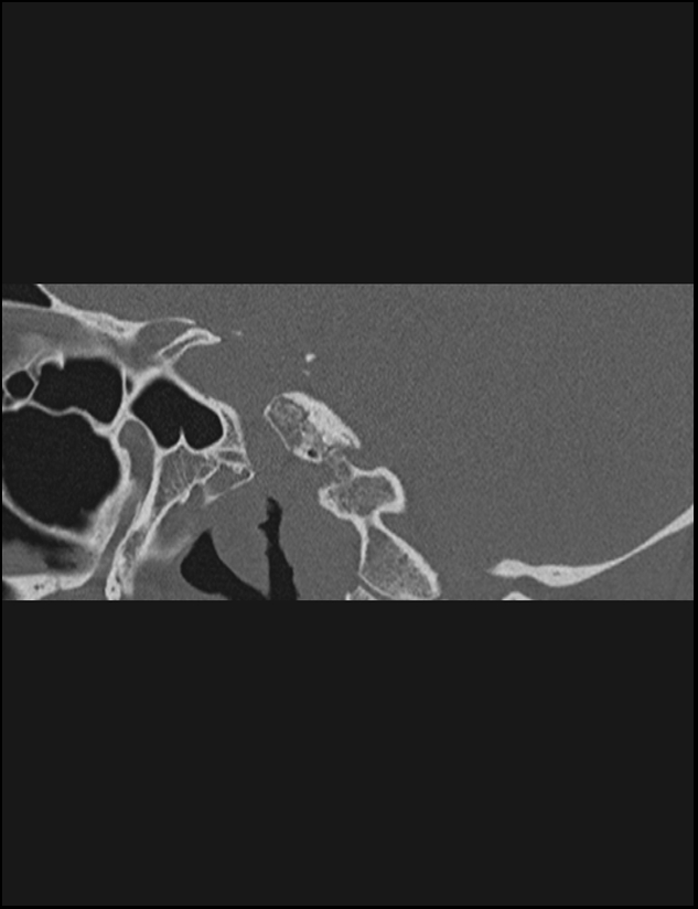Aberrant right internal carotid artery (Radiopaedia 65191-74198 Sagittal non-contrast 84).jpg