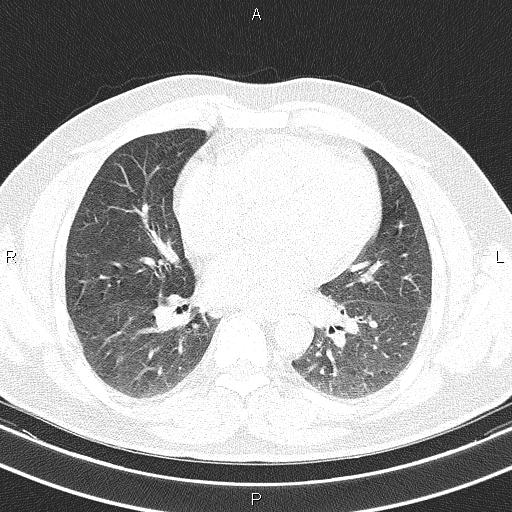 File:Aberrant right subclavian artery (Radiopaedia 87093-103354 Axial lung window 64).jpg