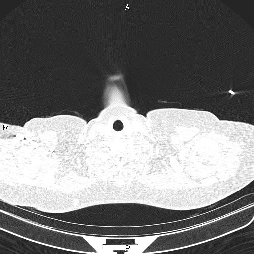 Aberrant right subclavian artery (Radiopaedia 87334-103629 Axial lung window 2).jpg