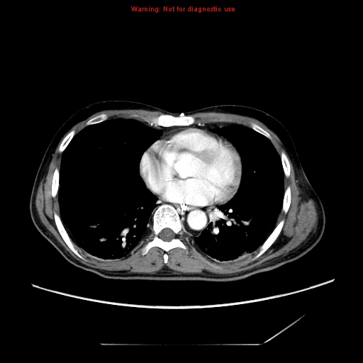 Aberrant right subclavian artery (Radiopaedia 9379-10071 Axial C+ arterial phase 41).jpg