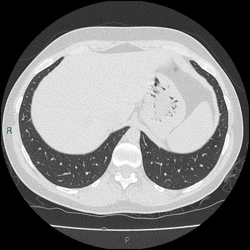 File:Accidental foreign body aspiration (seamstress needle) (Radiopaedia 77740-89983 Axial lung window 58).jpg