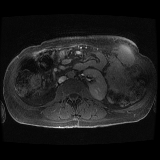 Acinar cell carcinoma of the pancreas (Radiopaedia 75442-86668 Axial late phase (~30 mins) 16).jpg