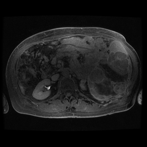 Acinar cell carcinoma of the pancreas (Radiopaedia 75442-86668 Axial late phase (~30 mins) 45).jpg