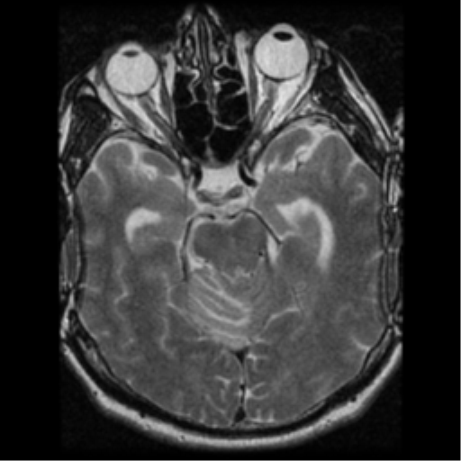 File:Acoustic schwannoma (Radiopaedia 39170-41387 Axial T2 14).png