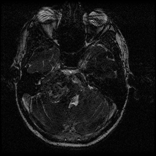 Acoustic schwannoma - eroding petrous apex (Radiopaedia 39674-42004 Axial T2 46).png