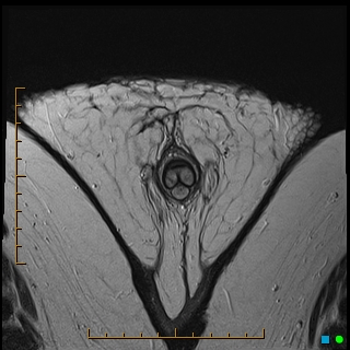 File:Acquired buried penis (Radiopaedia 39478-41797 Axial T2 31).jpg
