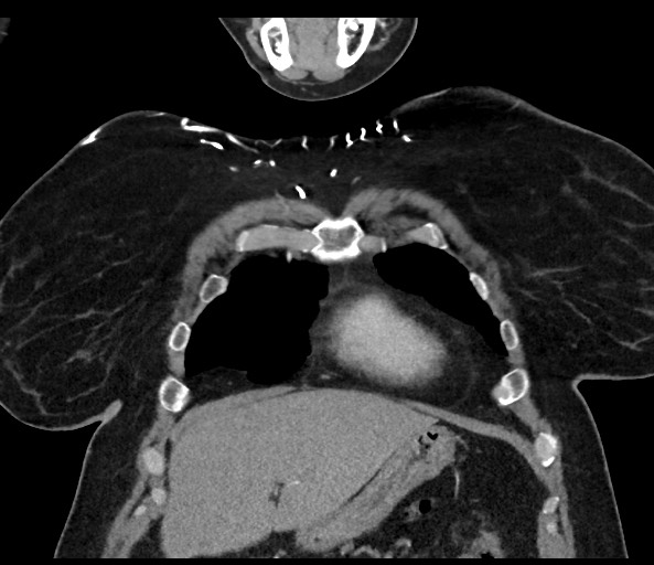 Acromioclavicular joint cyst (Radiopaedia 58455-65610 Coronal C+ arterial phase 38).jpg
