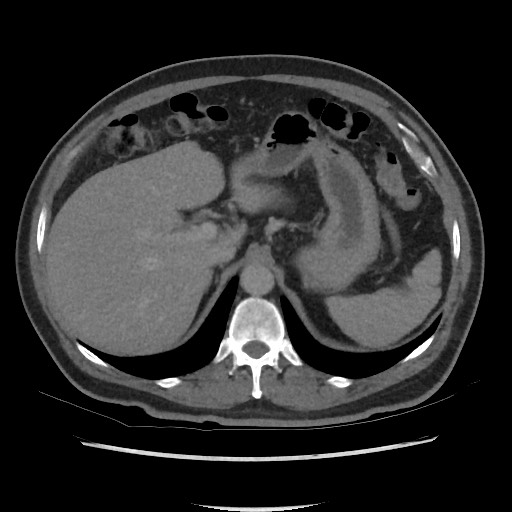 File:Active colonic bleed on CT (Radiopaedia 49765-55025 Axial C+ delayed 20).jpg