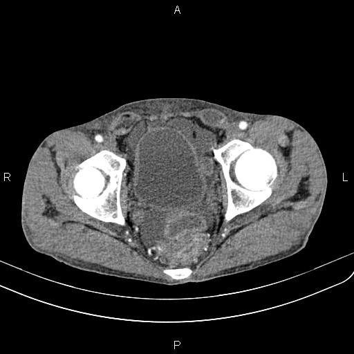 Active crohn disease (Radiopaedia 87133-103397 Axial C+ arterial phase 95).jpg