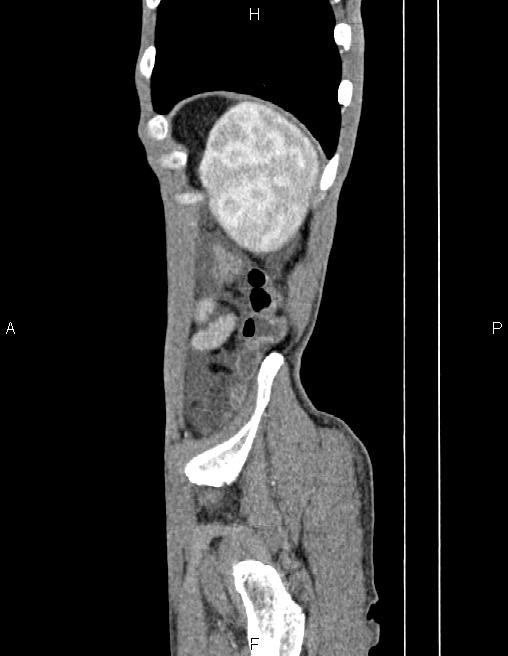 Active crohn disease (Radiopaedia 87133-103397 Sagittal C+ arterial phase 81).jpg