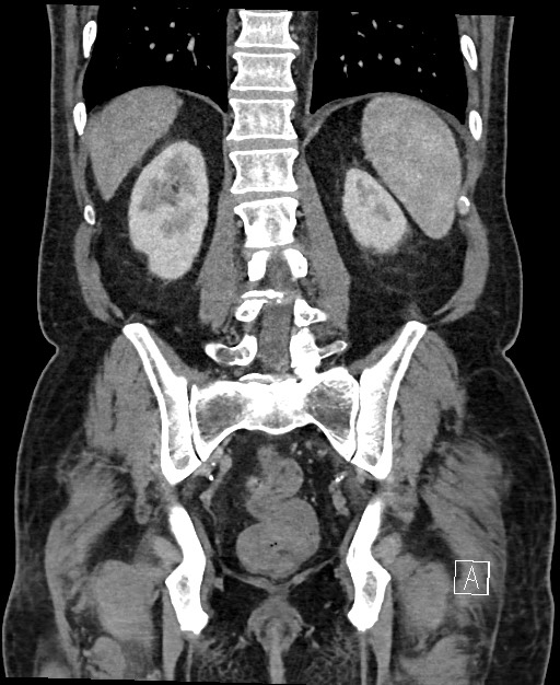 Active lower gastrointestinal bleeding - diverticular (Radiopaedia 61203-69106 Coronal C+ portal venous phase 99).jpg
