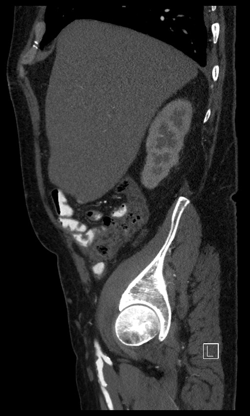 Active lower gastrointestinal bleeding - diverticular (Radiopaedia 61203-69106 Sagittal C+ arterial phase 124).jpg